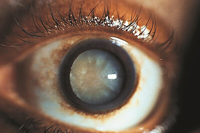 Closeup of an Eye With a Cataract